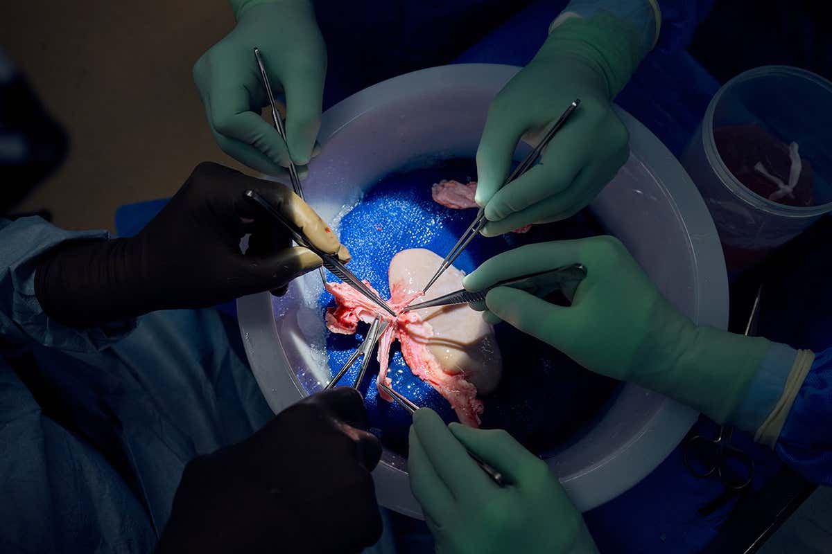Tissue from a pig kidney that has been transplanted into a brain-dead man
